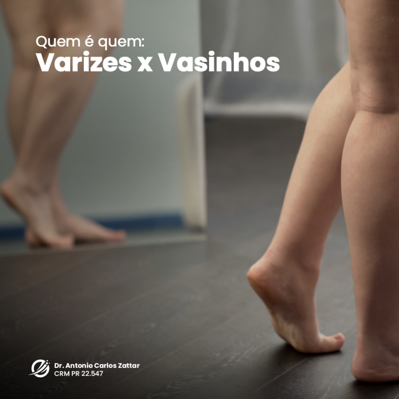 Diferenças entre vasinhos e varizes
